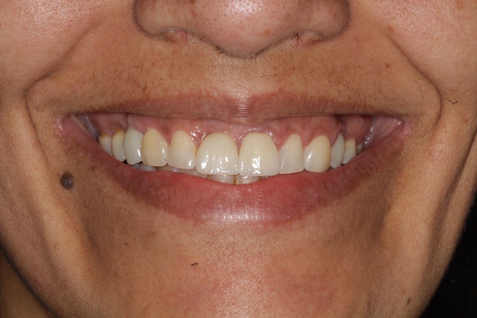 Sorriso depois do tratamento de reabilitação oral