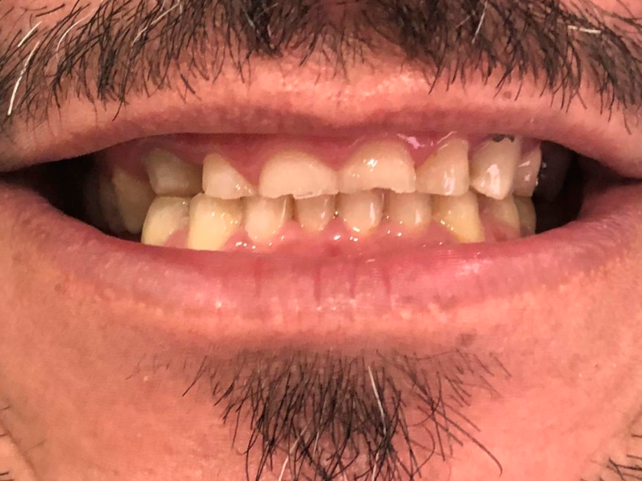 Sorriso antes do tratamento de implantes no tatuapé