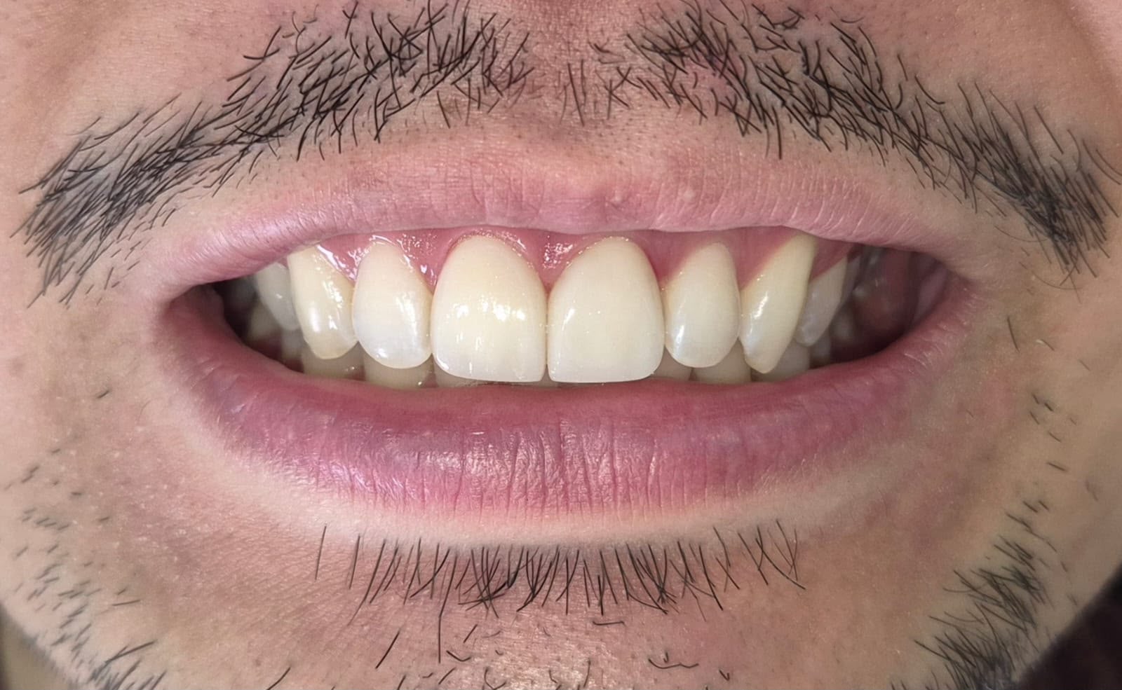 Sorriso depois do tratamento de lentes de contato