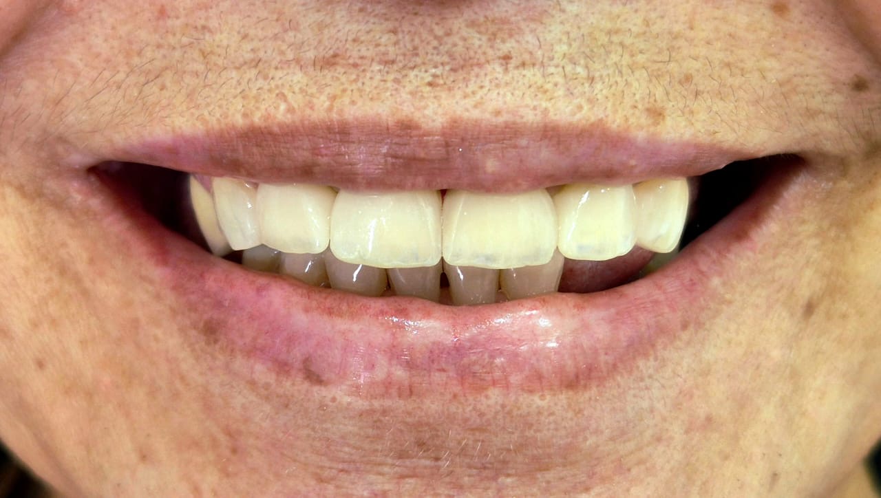 Sorriso depois do tratamento de estética do sorriso