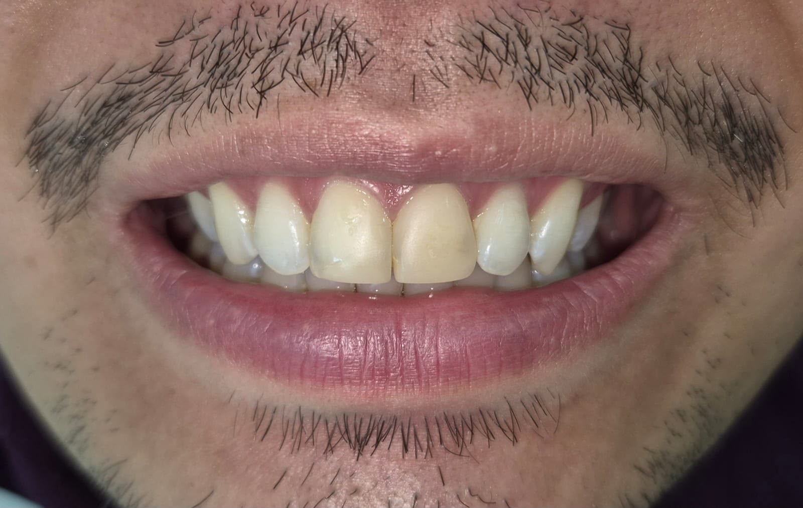 Sorriso antes do tratamento de lentes de contato