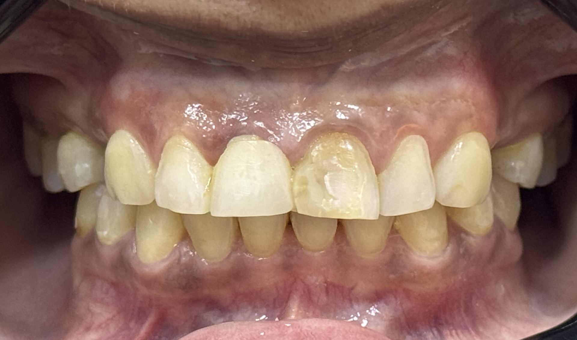 Sorriso antes do tratamento de reabilitação oral
