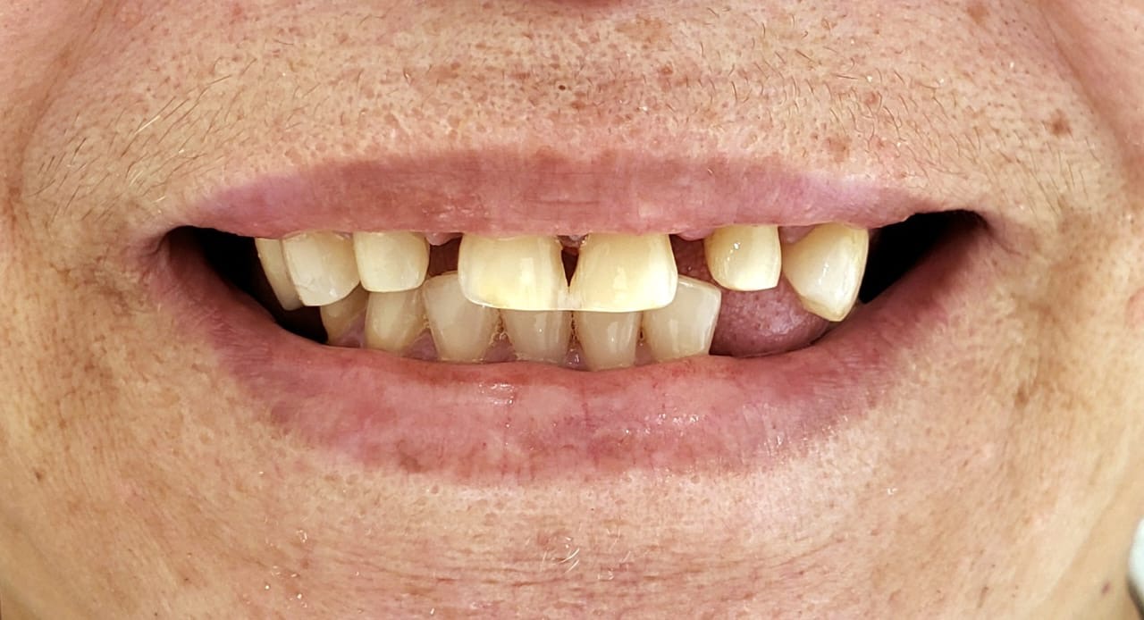 Sorriso antes do tratamento de estética do sorriso